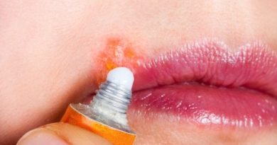 ATENCIÓN: Herpes labial: síntomas y tratamiento