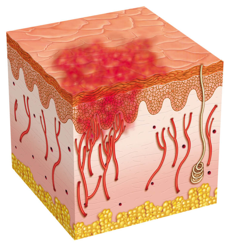 ULCERA