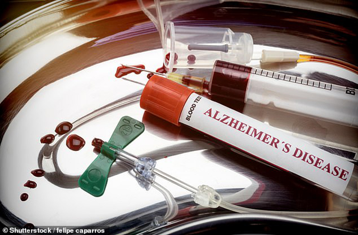 Análisis de sangre puede predecir en 94% si sufrirá de Alzheimer hasta 20 años antes
