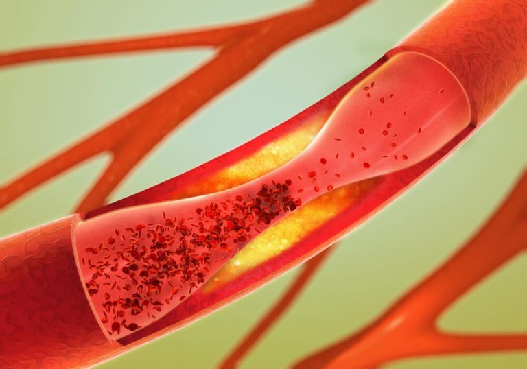 Enfermedad arterial periférica: síntomas, causas y tratamiento