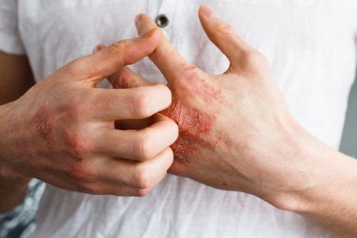 ATENCIÓN: ¿Qué es la dermatitis atópica?