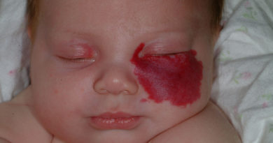 ATENCIÓN: Angiomas en bebés: ¿Qué hacer?