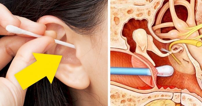 ATENCIÓN: 5 remedios naturales para limpiar tus oídos sin dañarlos