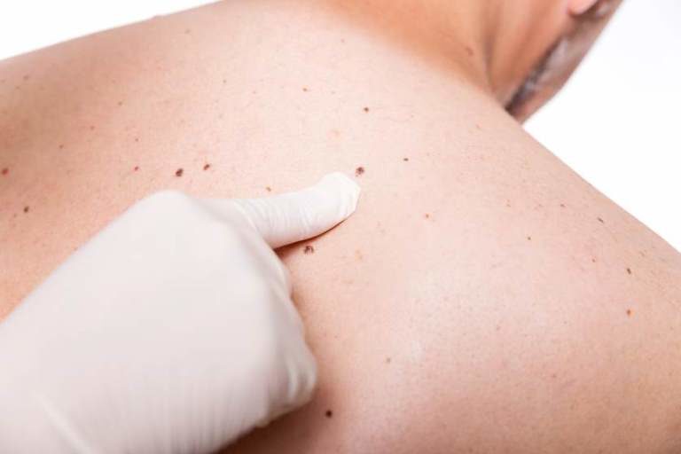 ATENCIÓN: Advierten sobre necesidad de educar a dominicanos respecto al cáncer de piel