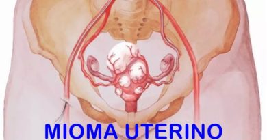 OJO: ¿Cómo saber si tienes miomas en el útero?