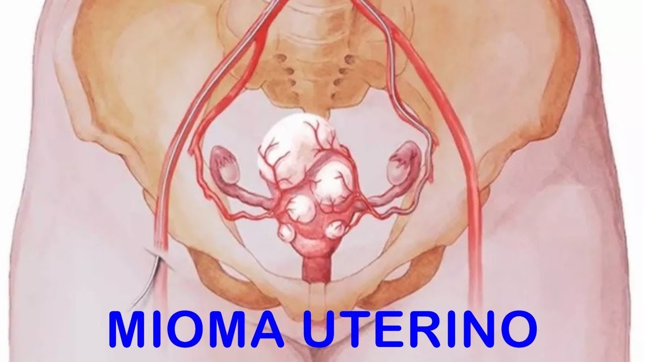 OJO: ¿Cómo saber si tienes miomas en el útero?