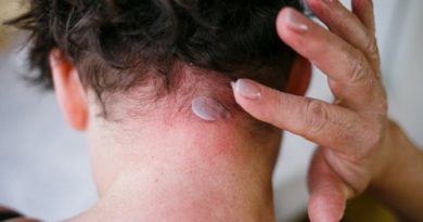ATENCIÓN: Dermatitis seborreica: síntomas y tratamiento