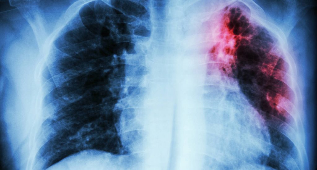 Pacientes con fibrosis pulmonar idiopática pueden desarrollar cáncer pulmonar