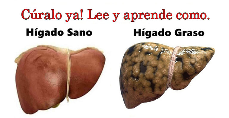 ATENCIÓN: Hígado graso: Combátelo con estos increíbles remedios naturales