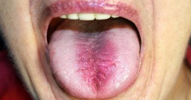 ATENCIÓN: Síndrome de la boca ardiente