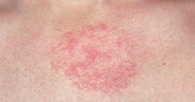 ¿Cómo prevenir la irritación de la piel?