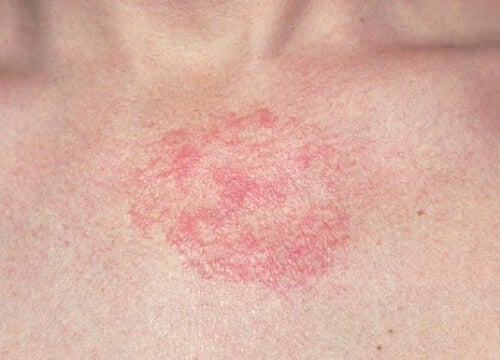 ¿Cómo prevenir la irritación de la piel?