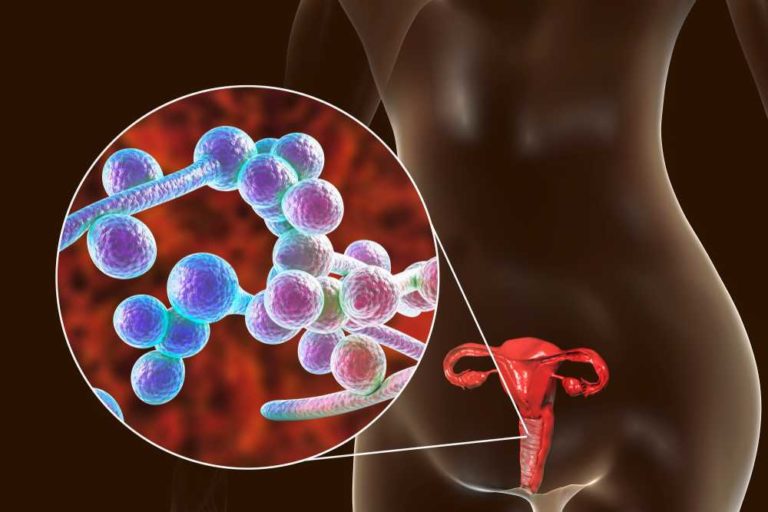 OJO: Infección Vaginal: Síntomas, tipos y Causas