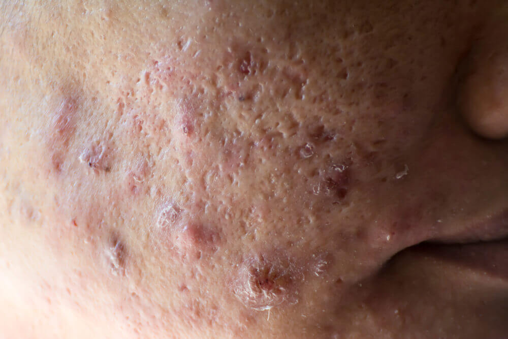 ATENCIÓN: ¿Qué es el acné quístico?