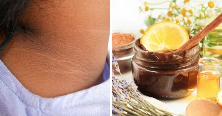 ATENCIÓN: Potentes remedios para quitar las manchas en el cuello en menos de una semana