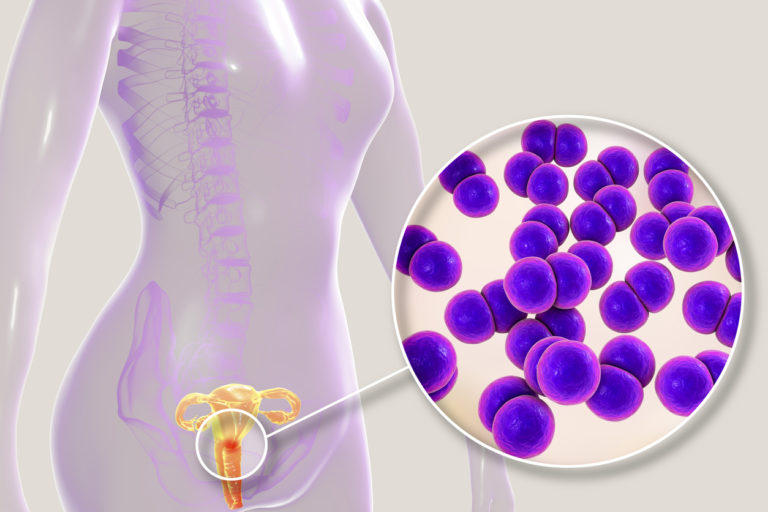 Female gonorrhea, medical concept