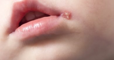 ATENCIÓN: ¿Qué es un herpes labial?
