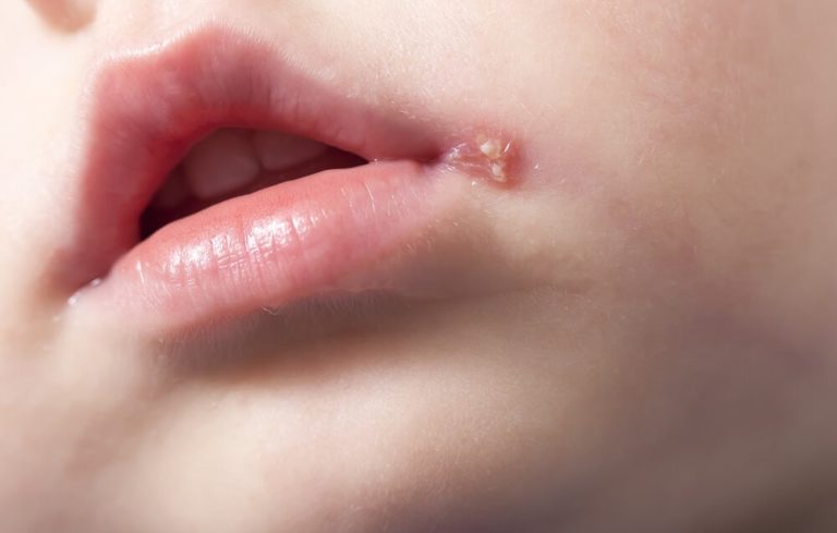 ATENCIÓN: ¿Qué es un herpes labial?
