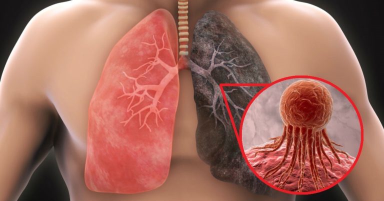 ALERTA: Visita de doctor: cuáles son las complicaciones que tiene el cáncer de pulmón