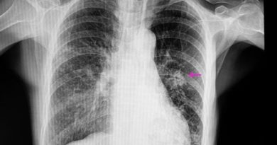 ATENCIÓN: Nódulo pulmonar, ¿qué significa?