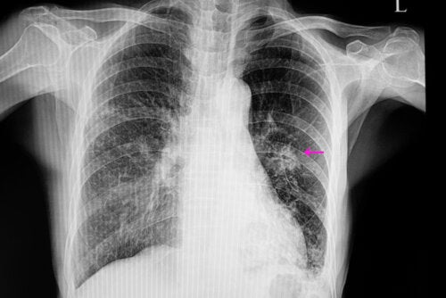 ATENCIÓN: Nódulo pulmonar, ¿qué significa?