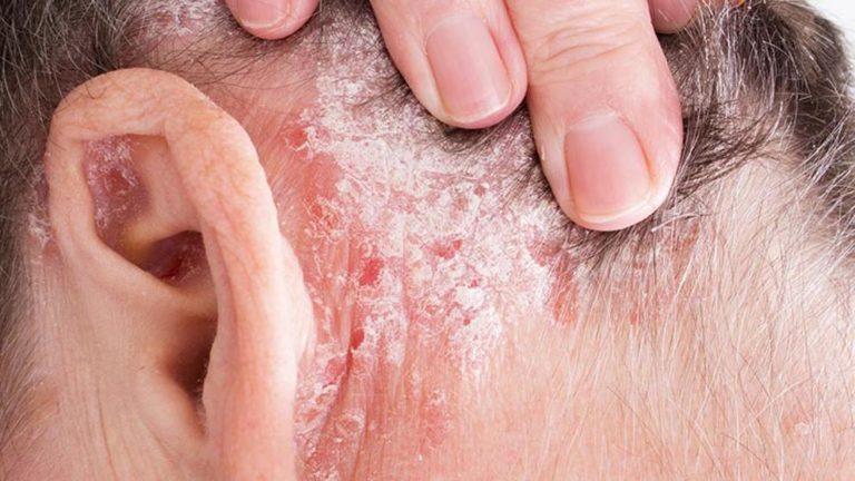 ATENCIÓN: Psoriasis: Síntomas, causas y cómo tratar la enfermedad