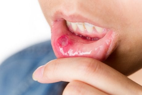 Heridas en la boca: causas y tratamientos