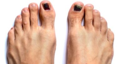 Uñas negras de los pies: ¿cómo tratarlas?