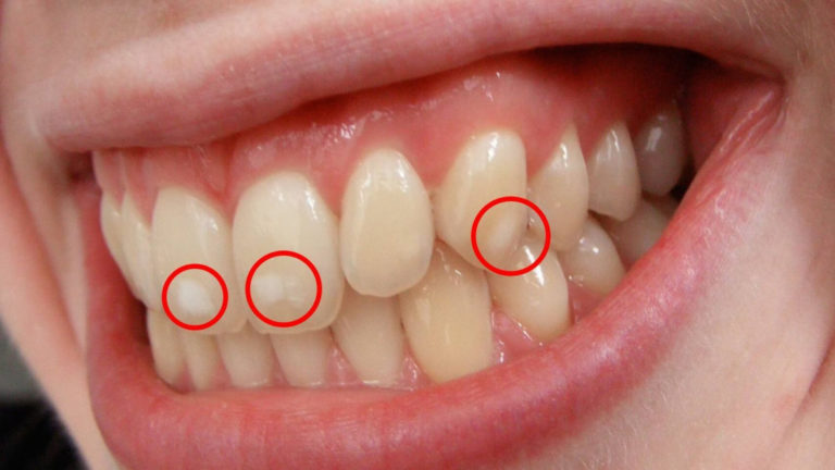 Demasiado flúor puede destrozar los dientes: la enfermedad tras las 'manchitas' blancas