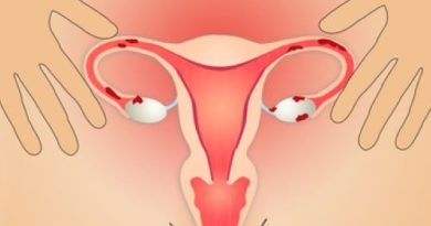 OJO: Endometriosis, tratamiento médico y terapias naturales