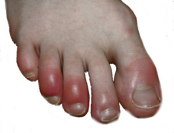 Los pies manifiestan patologías cardíacas que pueden ser detectadas por los podiatras