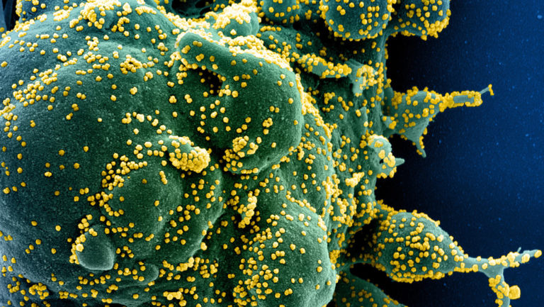 El covid-19 podría atacar las células del sistema inmunitario como el VIH