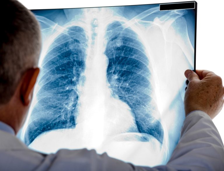 El diagnóstico precoz del cáncer de pulmón es responsabilidad de
