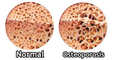 Tipos de osteoporosis Los tipos de osteoporosis son variados. En principio, se dividen en primarias y secundarias, pero hay más subclasificaciones que te comentamos en este artículo. Factores de riesgo de la osteoporosis Ectoparásitos: ácaros, pulgas y más TSH baja: ¿cuáles son las causas? Existen varios tipos de osteoporosis, pero ninguno de ellos es fácil de detectar. Uno de los problemas es el hecho de que esta enfermedad es asintomática, y se hace visible cuando aparecen las complicaciones. Mientras tanto, la situación avanza y pone en riesgo la salud. En la mayoría los tipos de osteoporosis hay dos factores de riesgo que deben ser tomados en consideración: la edad y el sexo. Esta patología afecta con más frecuencia a las mujeres y tiene mayor prevalencia a medida que aumenta la edad. ¿Qué es la osteoporosis? La osteoporosis es una enfermedad generalizada del sistema esquelético. Su principal característica reside en la pérdida de masa ósea y el deterioro de la microarquitectura de los huesos. Esto, en conjunto, lleva a que el tejido se vuelva más frágil, y por lo tanto haya mayor riesgo de fracturas. La densidad ósea comienza a reducirse a los 40 años, tanto en mujeres como en hombres. Se desconoce la razón por la cual se produce esta pérdida asociada a la edad, pero se calcula que oscila en un rango de entre el 0,3 y 0,5 % al año, a partir de esa edad. Lo más habitual es que la enfermedad se detecte luego de que haya una fractura. Esta puede presentarse en cualquier parte del cuerpo, muchas veces de forma espontánea o por un golpe mínimo. En general, siempre que haya una rotura de un hueso por fragilidad, debe considerarse osteoporótica. La densidad ósea determina la presencia o no de osteoporosis, en base a una prueba diagnóstica Sigue leyendo: 5 remedios para el dolor de huesos Tipos de osteoporosis Los tipos de osteoporosis se clasifican en dos grandes grupos: primarias y secundarias. Las primeras corresponden al mayor número de casos y no son fruto de otra enfermedad que las justifique en forma directa. Las segundas son consecuencia o acompañantes de otra patología o de su tratamiento. Osteoporosis primarias Dentro de las osteoporosis primarias se encuentran las siguientes: Idiopática juvenil: es un trastorno raro que aparece entre los 8 y los 14 años. Por lo general, remite de forma espontánea en los siguientes cuatro a cinco años, después de que surge. Idiopática del adulto joven: se presenta en hombres jóvenes y mujeres premenopáusicas. Se desconoce la causa y tiene una evolución variable. No siempre produce deterioro progresivo. Osteoporosis postmenopáusica Tipo I: tiene lugar en mujeres postmenopáusicas, de 51 a 75 años. El curso es acelerado, y a veces desproporcionado. Las fracturas más frecuentes se presentan en las vértebras y en segmento distal del antebrazo o muñeca. Osteoporosis senil Tipo II: afecta a hombres y mujeres mayores de 70 años, y de manera característica provoca fracturas en el cuello femoral o cadera, la extremidad proximal del húmero u el hombro, la tibia y la pelvis. Osteoporosis secundarias El segundo de los dos grandes tipos de osteoporosis son las secundarias, las cuales aparecen a cualquier edad, acompañadas de otra patología. Su denominación de secundarias responde al hecho de que se derivan de otra enfermedad como un síntoma más. Los principales factores de riesgo para padecer una osteoporosis secundaria son los siguientes: Enfermedades endocrinológicas: pueden ser estados hipogonadales como la menopausia precoz, el síndrome de Turner; o patologías endocrinas como la acromegalia, la insuficiencia suprarrenal y la diabetes mellitus tipo I. Celiaquía: incluye este grupo a enfermedad celíaca, malabsorción, gastrectomía, cirrosis biliar primaria, enfermedad inflamatoria intestinal, insuficiencia pancreática exocrina y enfermedad hepática grave. El problema es la falta de una buena absorción de nutrientes esenciales para el hueso, como el calcio. Trastornos hematológicos: las leucemias y los linfomas, así como el mieloma múltiple, si toman a la médula ósea entre sus lugares de efectos secundarios, terminan con la afectación del hueso. Reumatismos: la espondilitis anquilosante y la artritis reumatoide. Trastornos genéticos: múltiples enfermedades heredades tienen como síntoma la osteoporosis. Del mismo modo, la osteoporosis primaria puede adquirir formas particulares en base a la carga genética de la paciente. Uso de ciertos medicamentos: como anticoagulantes, glucocorticoides y drogas citotóxicas. Los pacientes oncológicos y trasplantados están en mayor riesgo por el uso de fármacos que afectan la replicación celular. Cuando la osteoporosis se acompaña de fracturas se habla de un tipo grave de la enfermedad También puede interesarte: Consejos de nutrición para pacientes con riesgos de osteoporosis Todos los tipos de osteoporosis siguen el mismo diagnóstico Para determinar el estado de salud de los huesos se lleva a cabo un examen que es la prueba de densidad ósea. Este permite establecer si hay osteoporosis, estimar el riesgo de que se presente una fractura, y también verificar la forma como el tejido óseo responde a un tratamiento específico. En esta prueba se mide la densidad mineral ósea con un resultado que se expresa en una cifra. La lectura del examen debe ser realizada por un médico, en base a un consenso internacional que clasifica los valores de la manera siguiente: Entre +1 y -1 es un hueso normal en lo que se refiere a densidad. Desde -1 hasta -2.5 se considera que la densidad ósea es baja y se llama osteopenia. Inferior a -2.5 es sinónimo de osteoporosis. Menos de -2.5 con presencia de alguna fractura es la osteoporosis grave. Tienen más riesgo de padecer la enfermedad las mujeres menopáusicas, los mayores de 75 años, y aquellas personas con antecedentes familiares de osteoporosis. El bajo consumo de calcio y un estilo de vida sedentario son otras situaciones que contribuyen a la aparición del trastorno. Después de los 40 años, es recomendable que las mujeres se realicen pruebas de densidad ósea con cierta regularidad. De esta manera, el rastreo puede detectar a tiempo una osteoporosis incipiente que tenga tratamiento, evitando futuras fracturas.