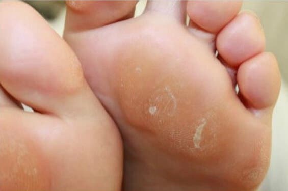Cremas naturales para eliminar los callos de los pies