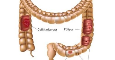 Enfermedades comunes del colon: ¿Cómo prevenirlas?