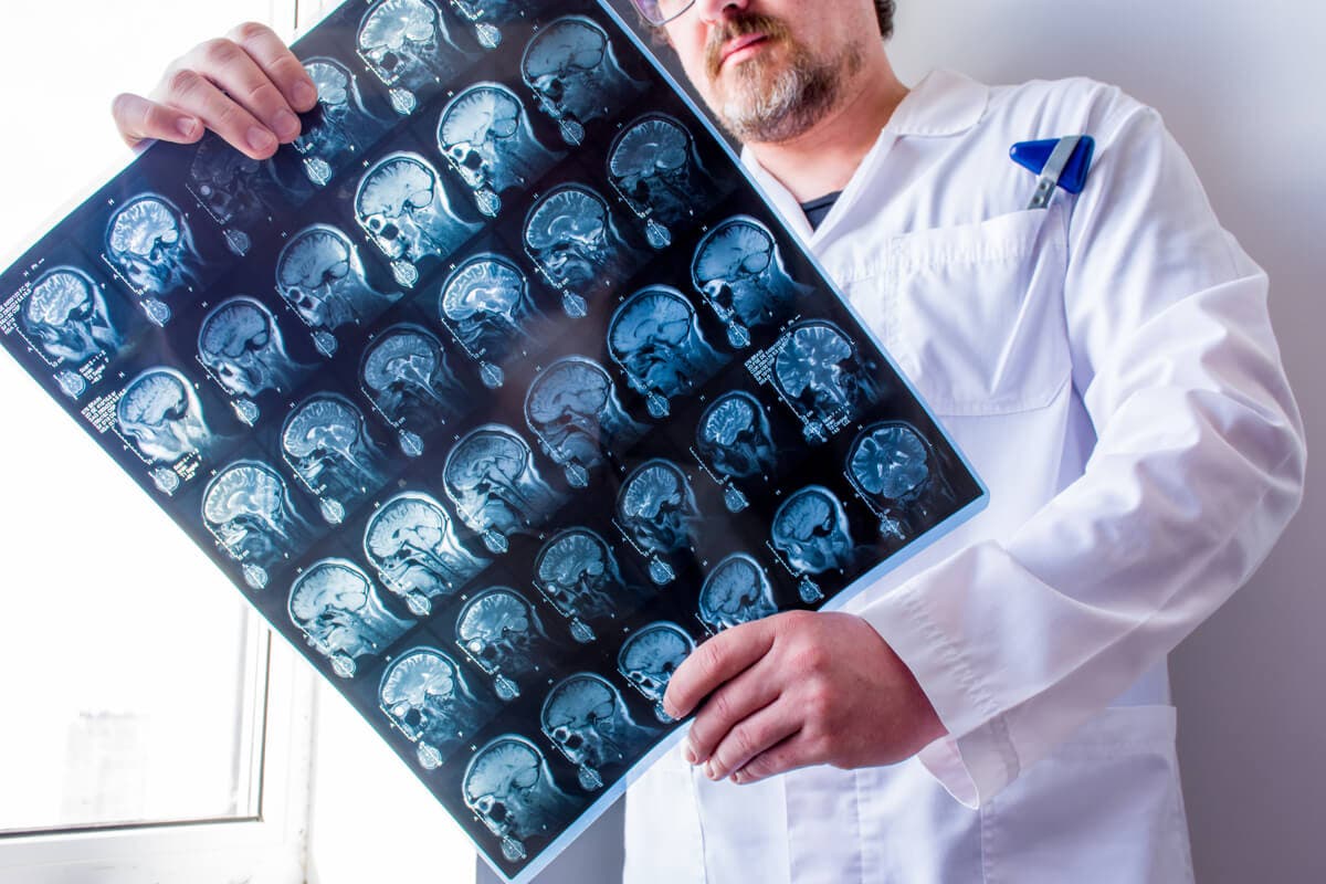 Tumor cerebral: síntomas y causas