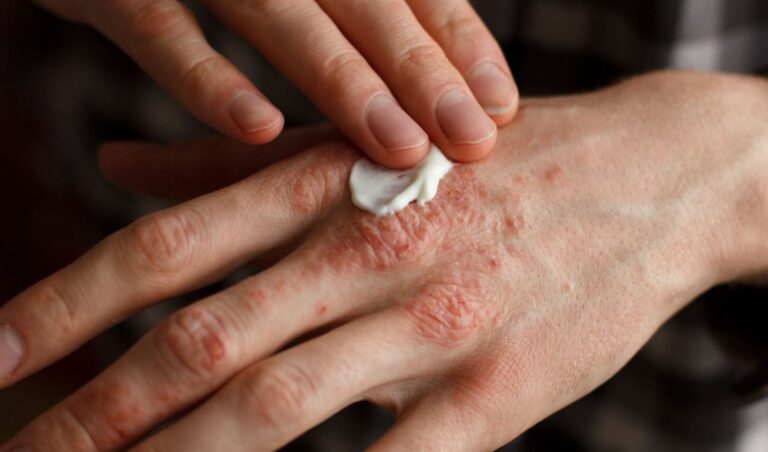 Personas con psoriasis pueden ser estigmatizadas