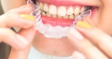 Retenedores dentales: ¿cuándo son necesarios?