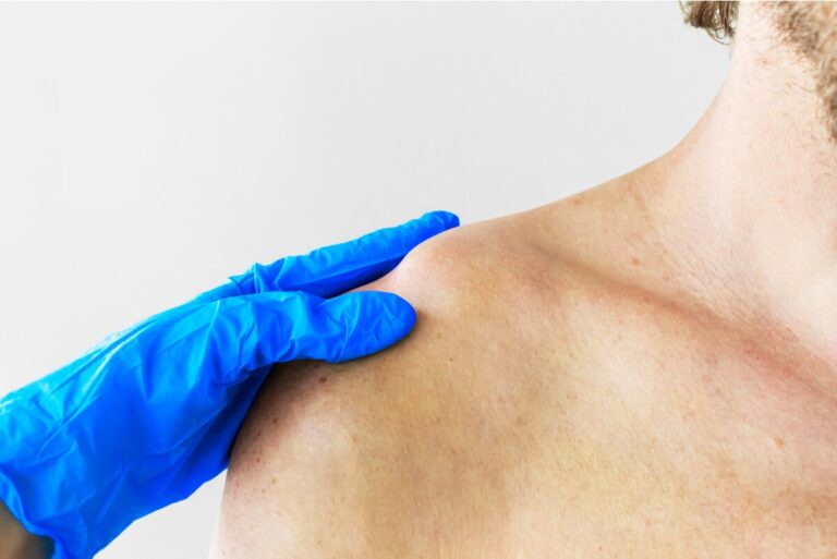 Fractura de clavícula: ¿qué consecuencias tiene?