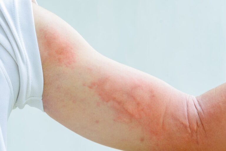 Lamotrigina: usos y efectos secundarios