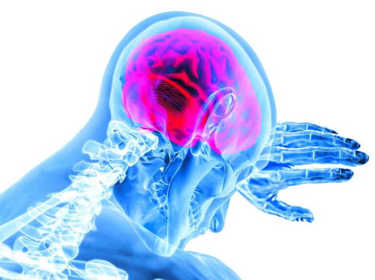 Enfermedad cerebrovascular es segunda causa de muerte en el mundo
