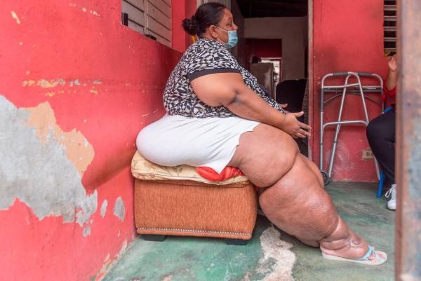 Mujer con casi 600 libras clama por ayuda para cirugía bariátrica