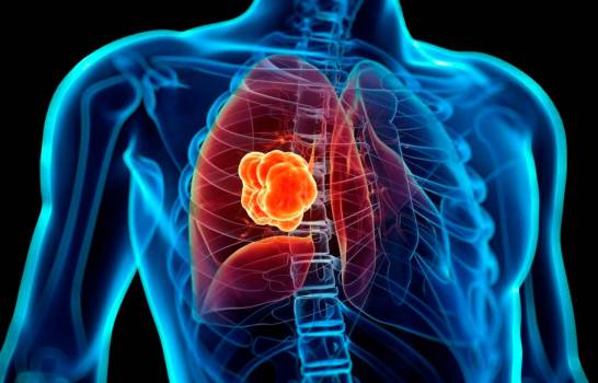 El 90 % de pacientes con cáncer de pulmón muere debido a la detección tardía