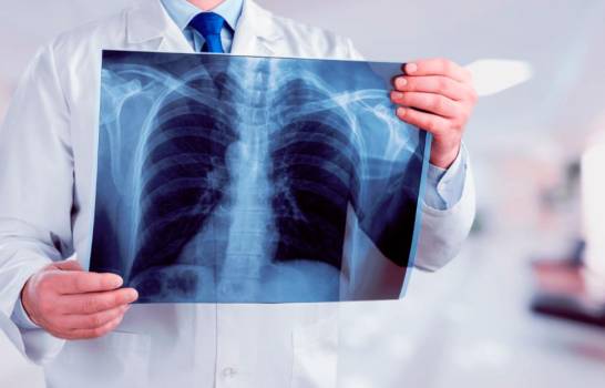 Casos de tuberculosis mantienen caída pero preocupa el impacto de la pandemia