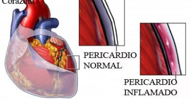 Pericarditis: síntomas, causas y tratamiento