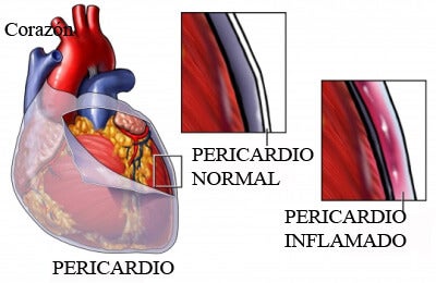Pericarditis: síntomas, causas y tratamiento