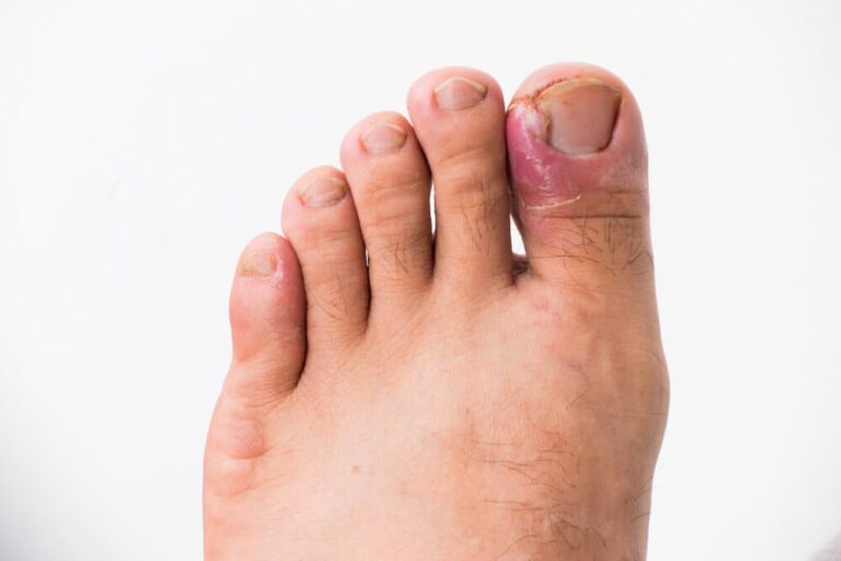 Maneras de prevenir una infección por hongo en las uñas