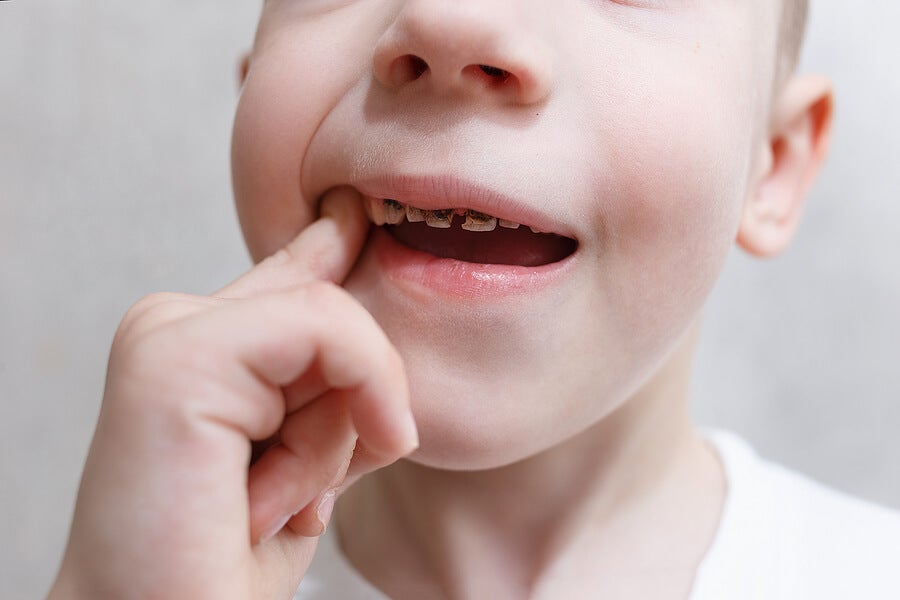 Principales problemas dentales en niños