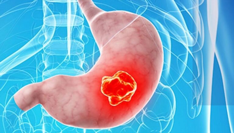 FDA aprueba primera inmunoterapia para cáncer gástrico